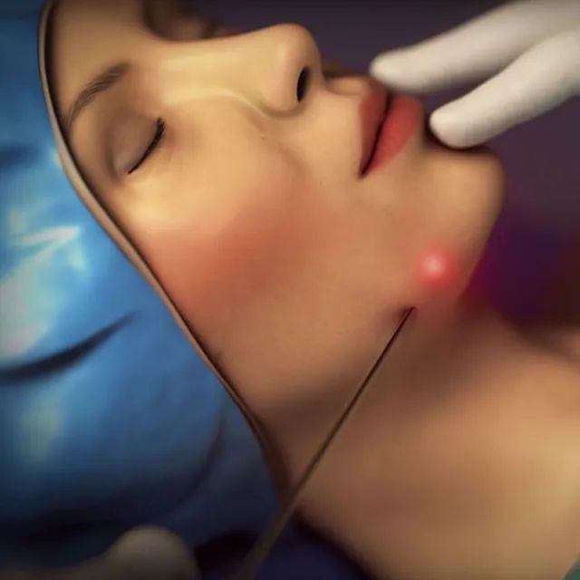 Endolaser / Endolift - Locação de Equipamentos 