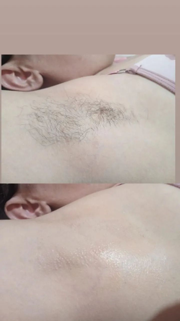 Epilaçao em mulheres ? - Foto 2