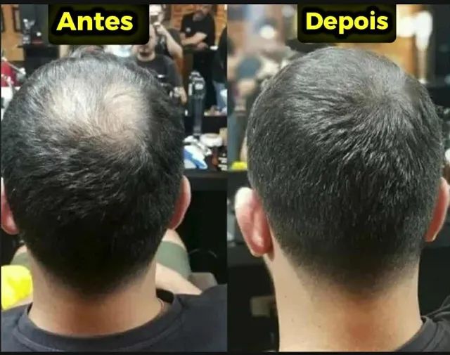Queda de cabelo