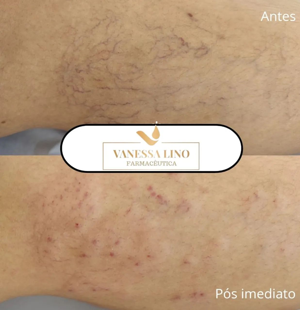 SECAGEM DE VASINHOS  ( microvasinhos) - Foto 2
