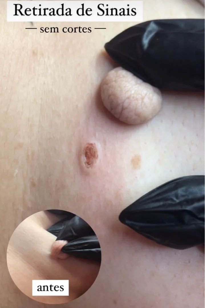 Remoção de Sinais e Verrugas @@