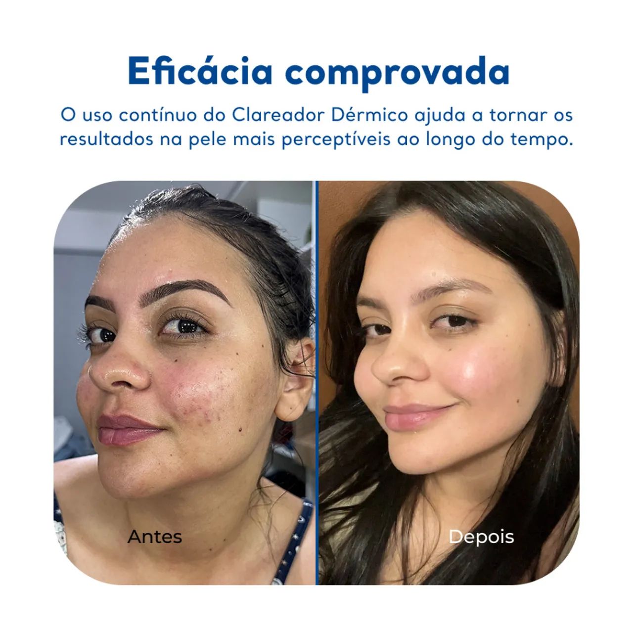 Clareador de Manchas para Virilha e Axilas  - Foto 2