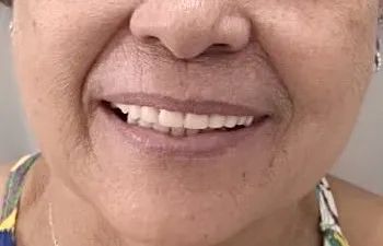 Próteses dentárias  - Foto 2