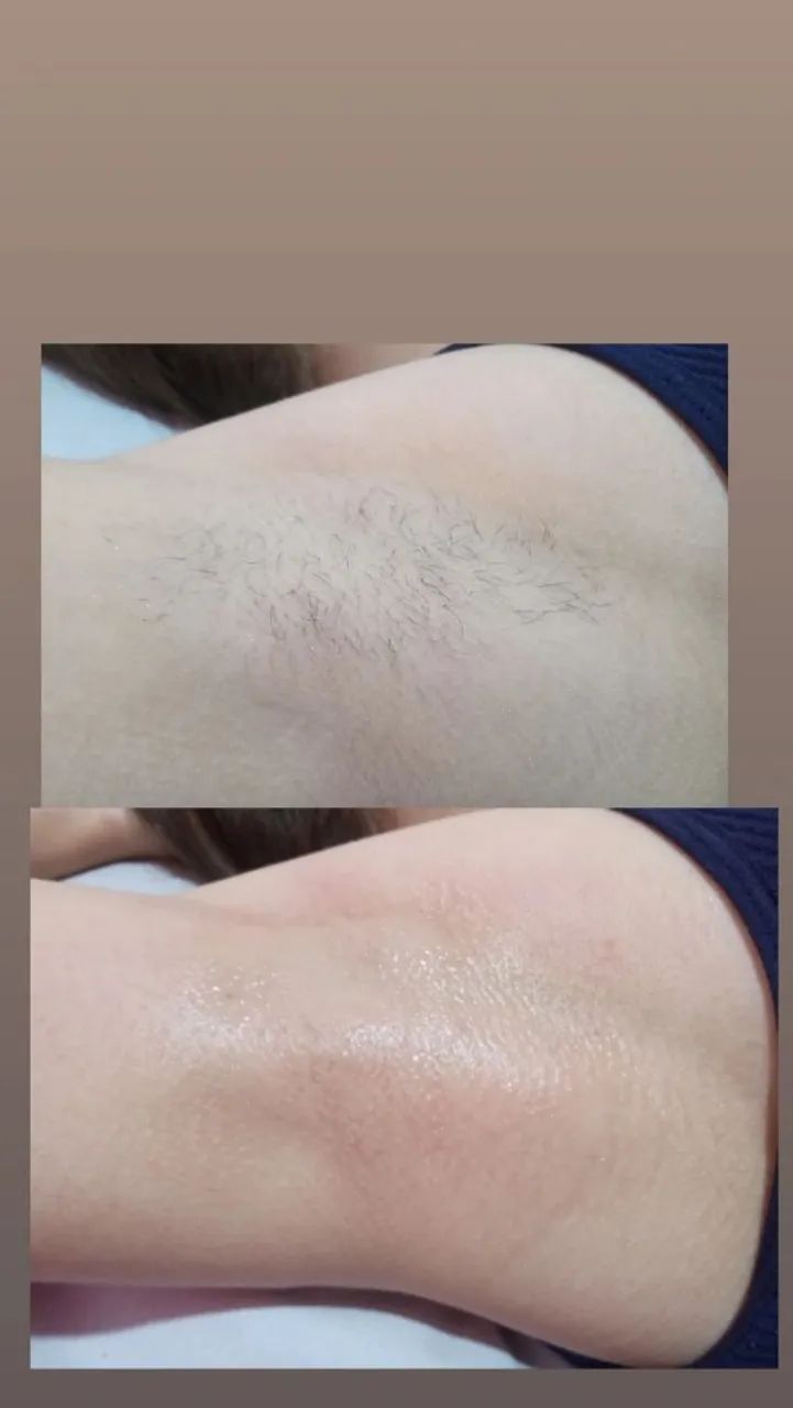 Epilaçao em mulheres ? - Foto 3