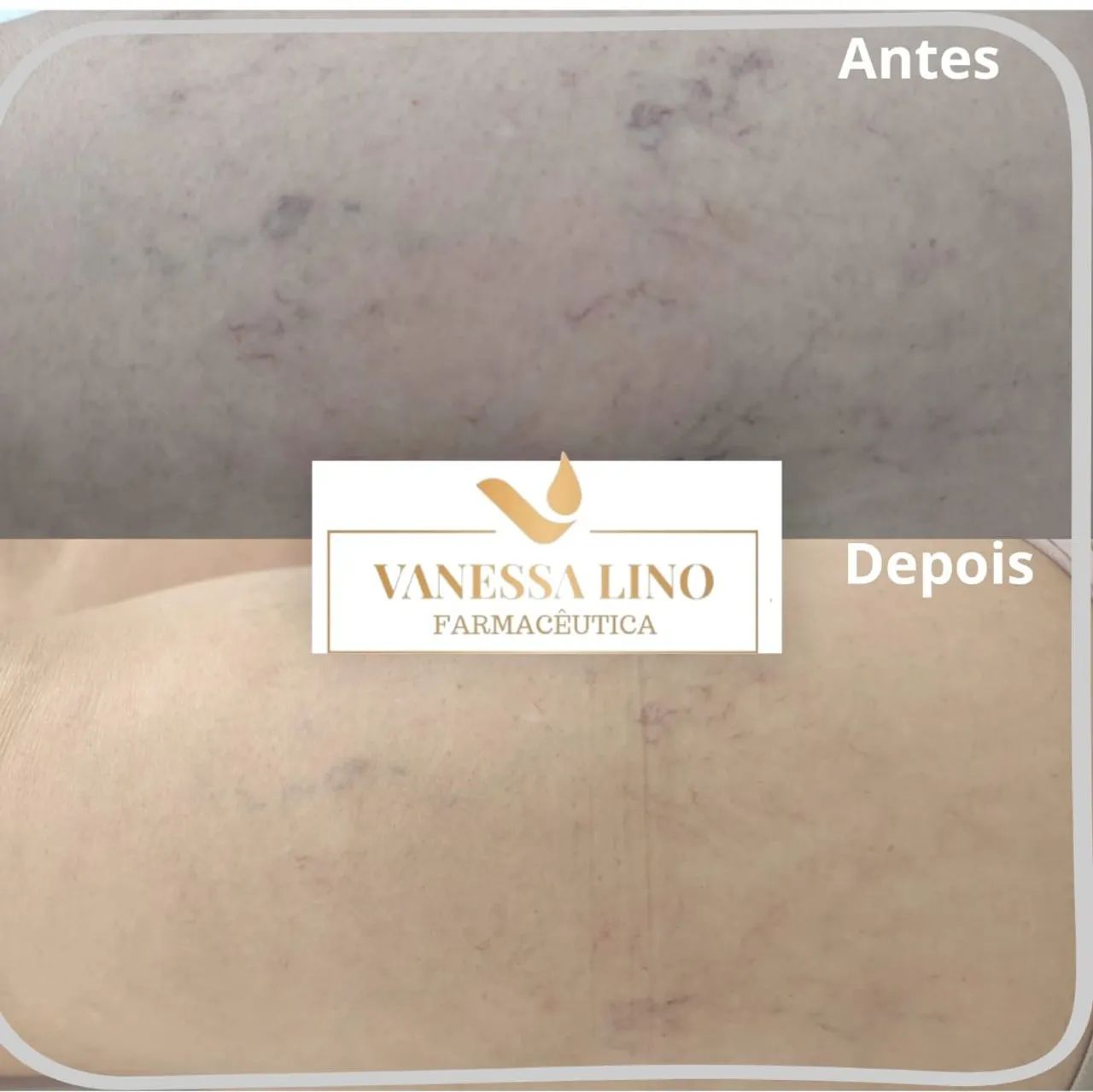 SECAGEM DE VASINHOS  ( microvasinhos) - Foto 3