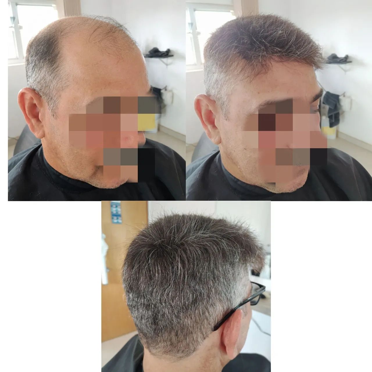 Prótese Capilar preço já incluso a prótese e a colocação  - Foto 2
