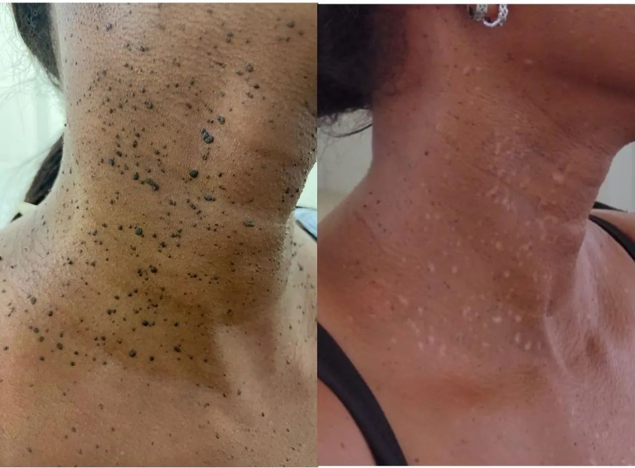 Cauterização Verruga  - Foto 3