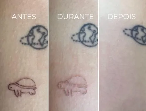 Remoção de tatuagem a laser