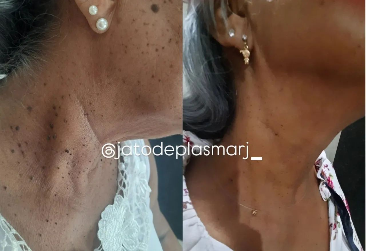 Cauterização Verruga  - Foto 5