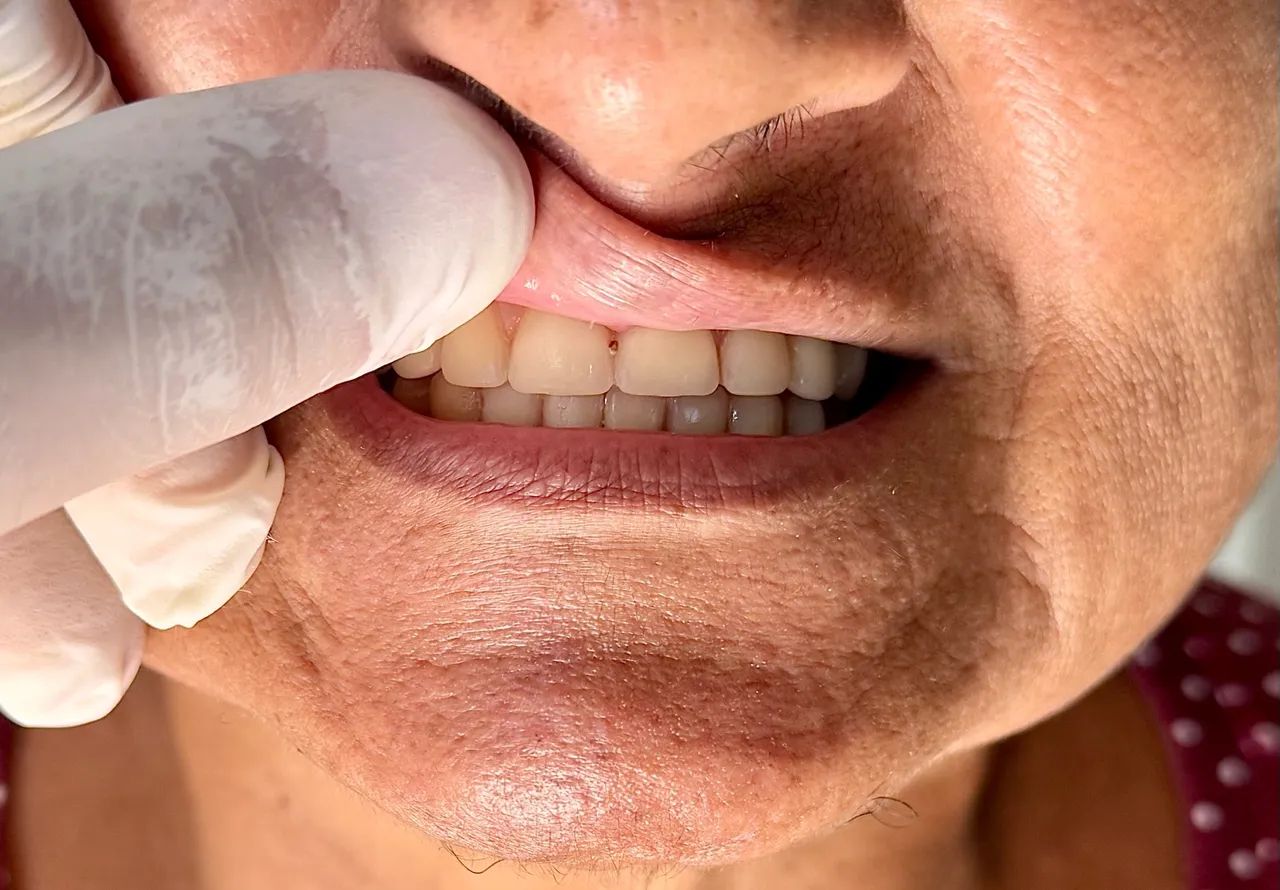 Próteses dentárias  - Foto 3