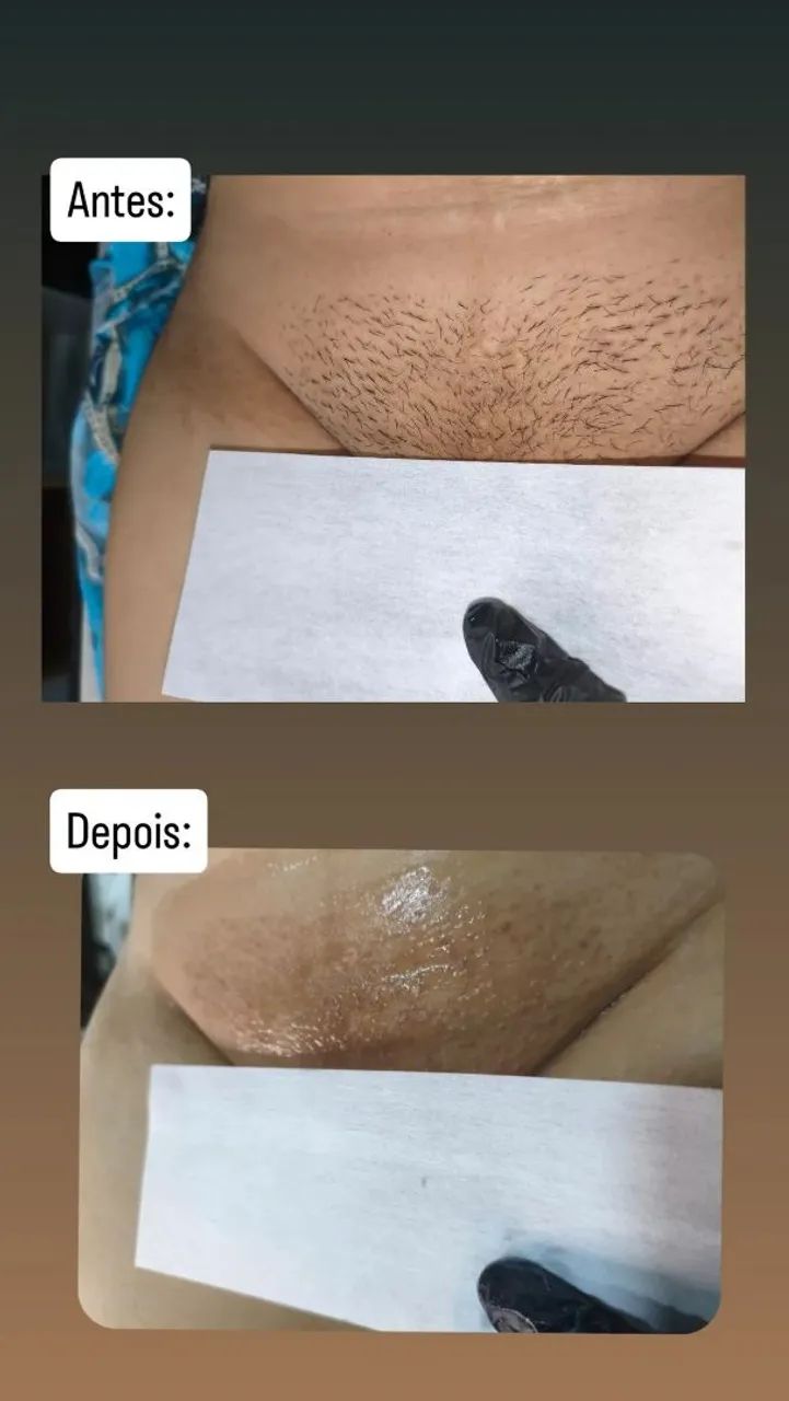 Depilação cera - Foto 3