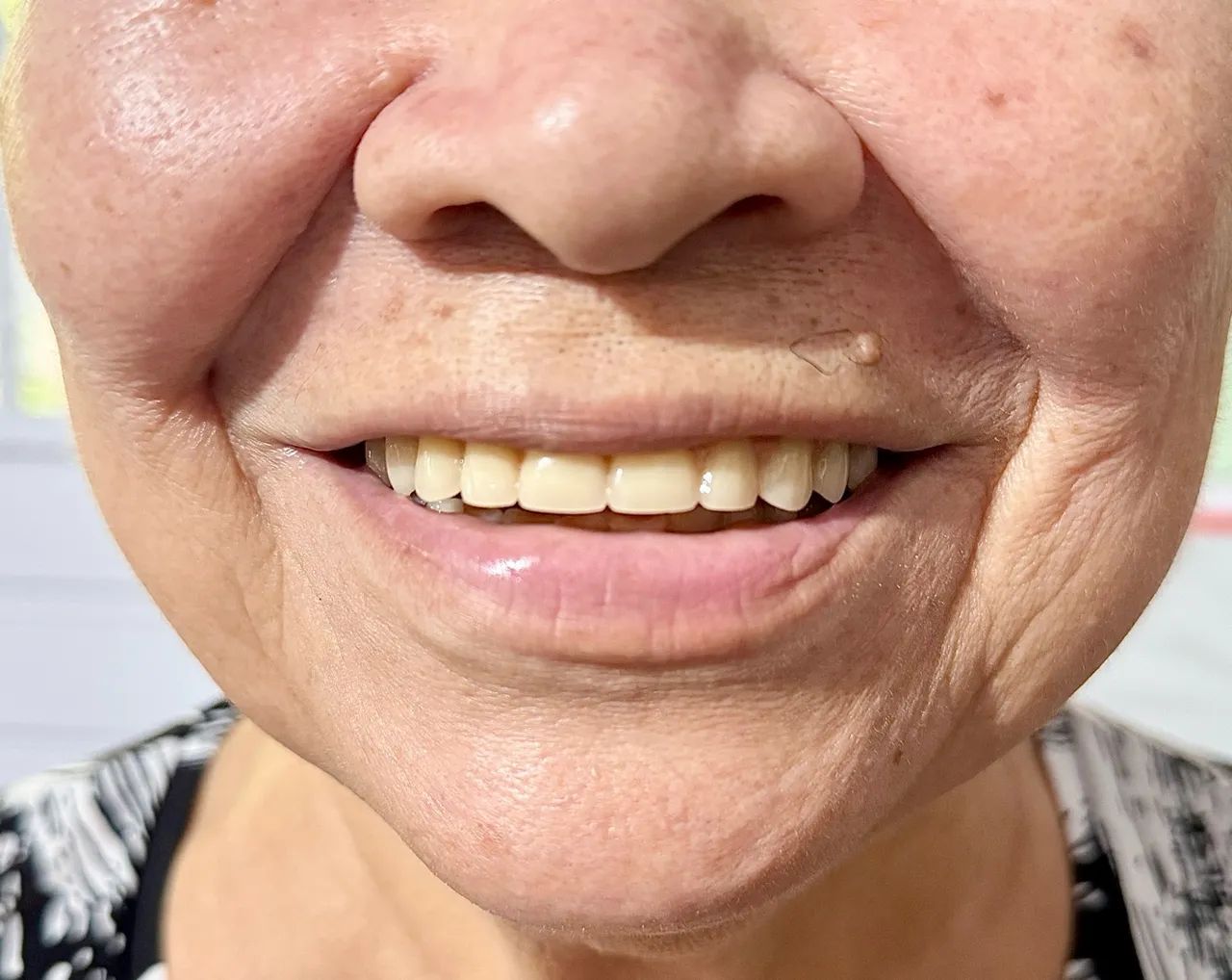 Próteses dentárias  - Foto 4