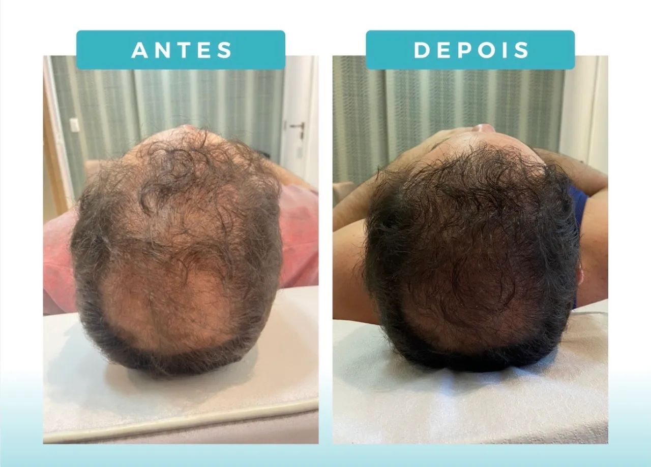 Tratar queda de cabelo - Foto 2