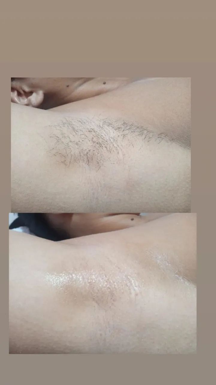 Epilaçao em mulheres ? - Foto 5