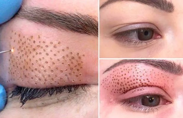 Tratamentos Faciais e Corporal - Thatybeauty - Foto 5