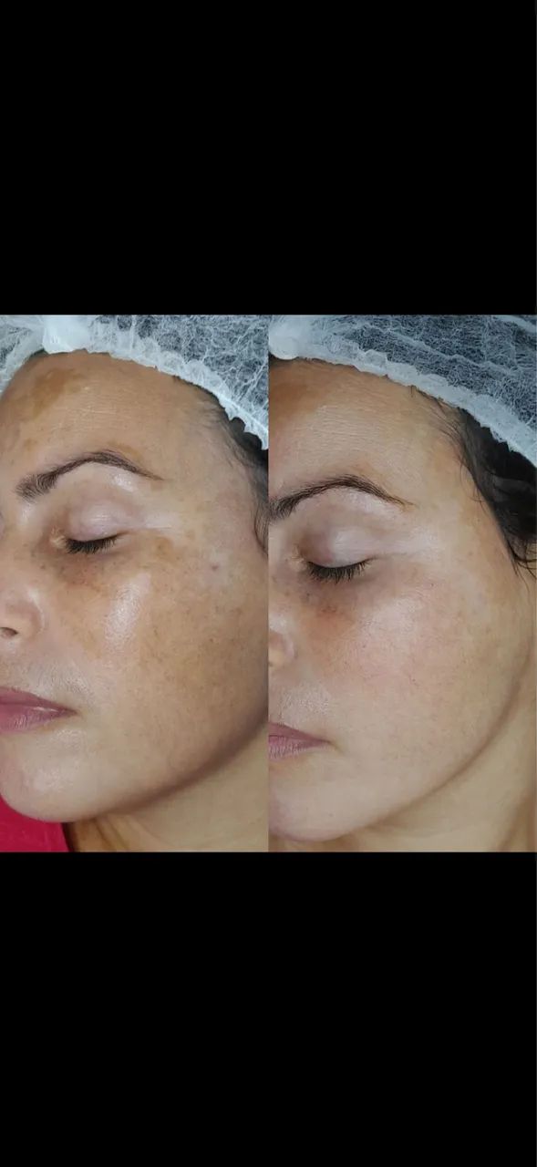 Tratamento para melasma completo e personalizado  - Foto 3