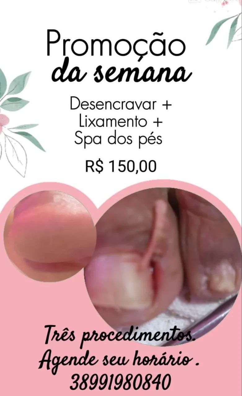 Tratamento de podologia especializada  - Foto 5