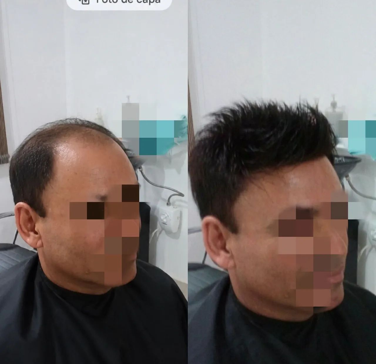 Prótese Capilar preço já incluso a prótese e a colocação  - Foto 3