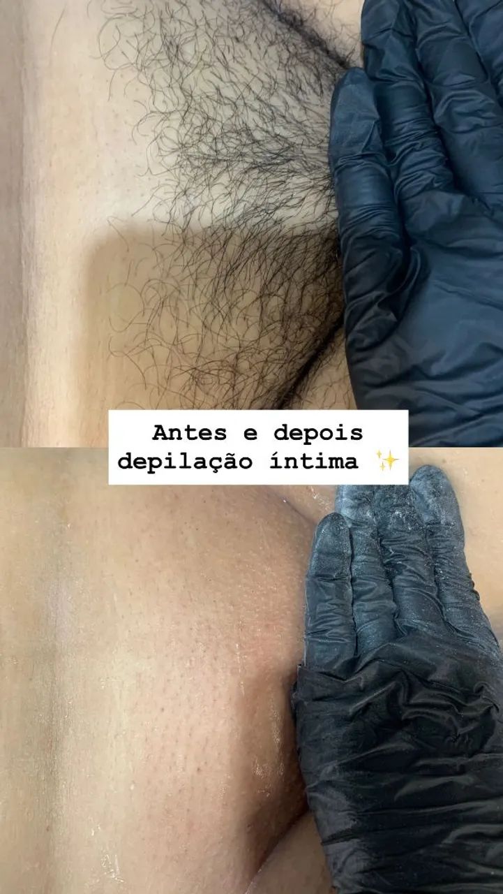 Depilação cera - Foto 2