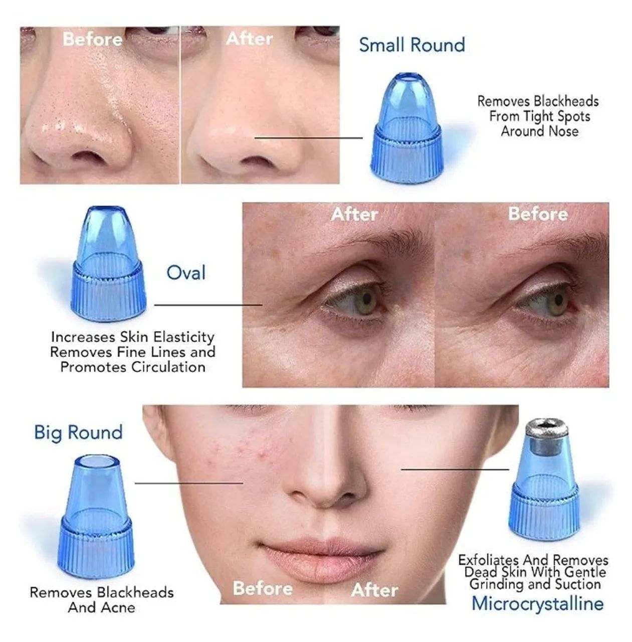 Aparelho limpeza facial/removedor cravos e espinhas - Foto 2