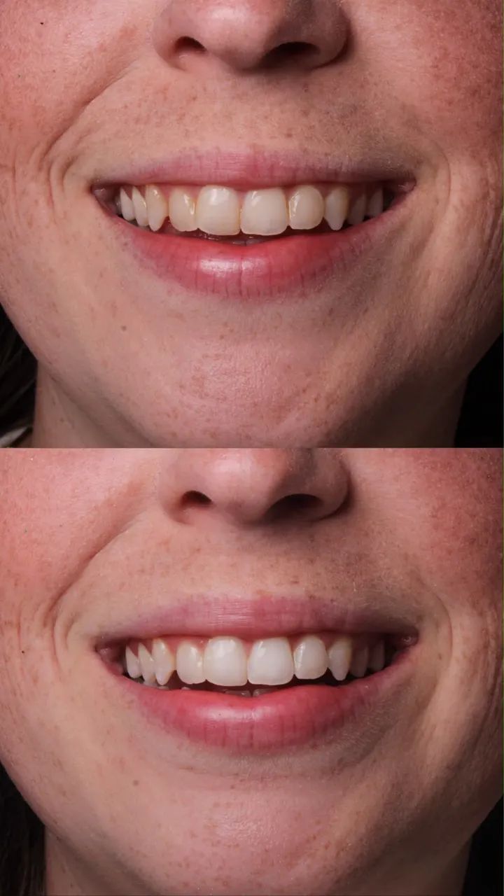 Clareamento dental em consultório  - Foto 5