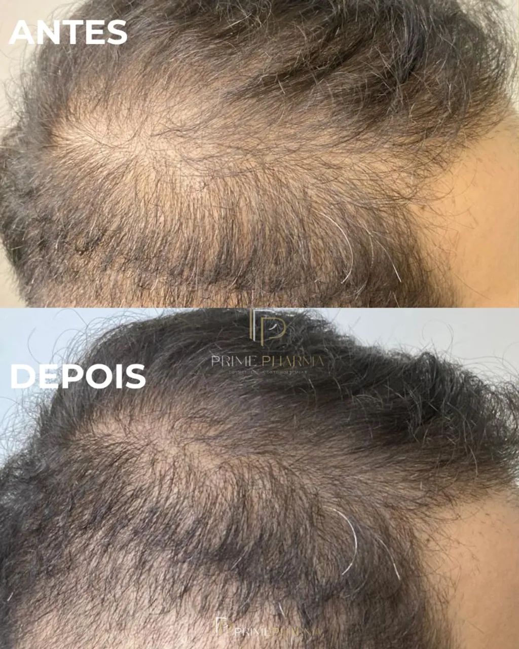 Queda de cabelo x Alopecia 