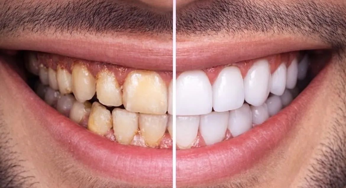 Dentes mais brancos e bonitos com Facetas de Resina 