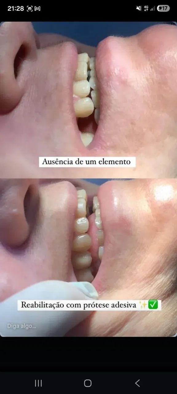 Protese dentaria (Dentadura) - Foto 2