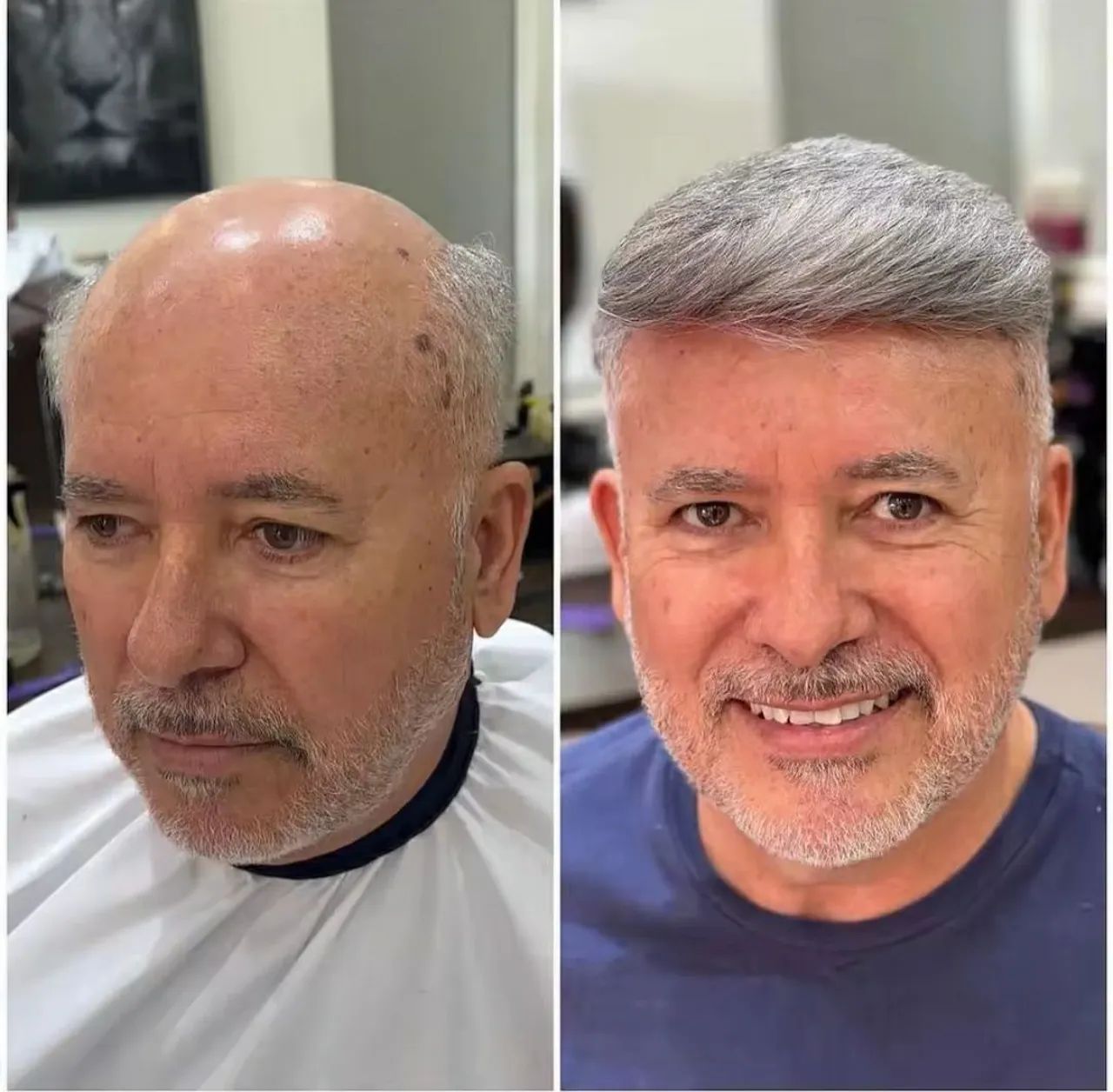 Prótese Capilar preço já incluso a prótese e a colocação  - Foto 4