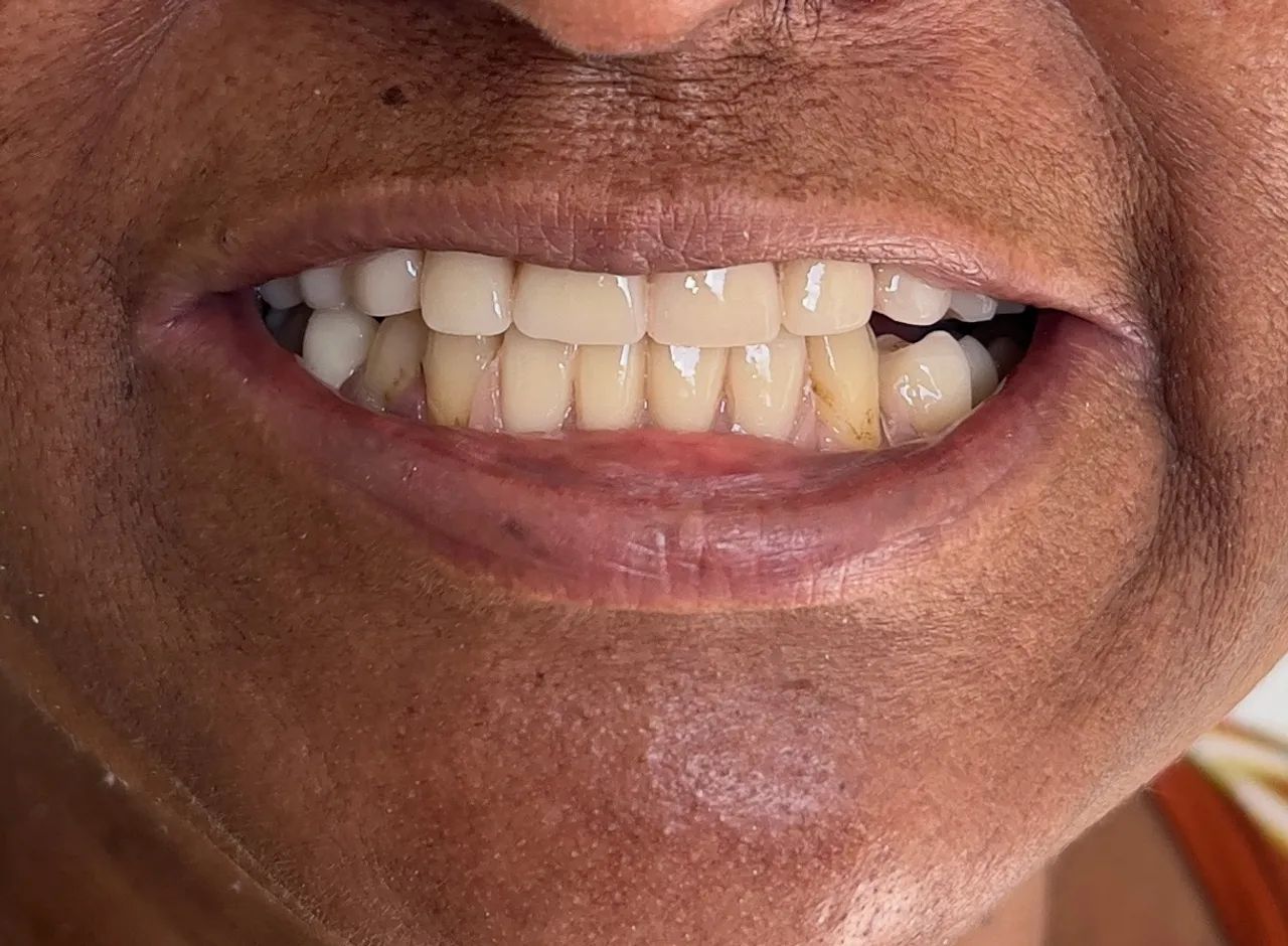 Próteses dentárias  - Foto 5