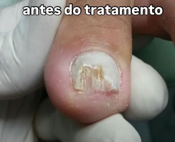 Podologo especializado em tratamento com Laser em micose de unha - Foto 2