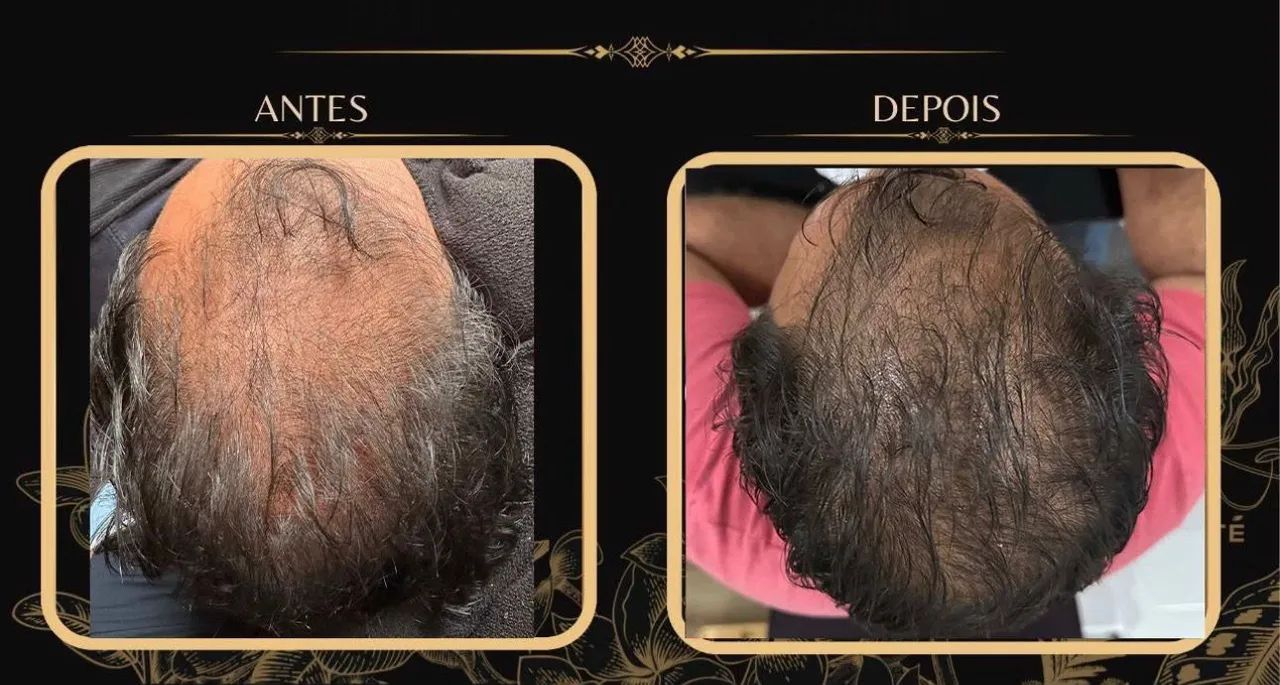 Queda de cabelo x Alopecia  - Foto 2