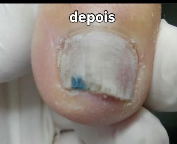 Podologo especializado em tratamento com Laser em micose de unha - Foto 3