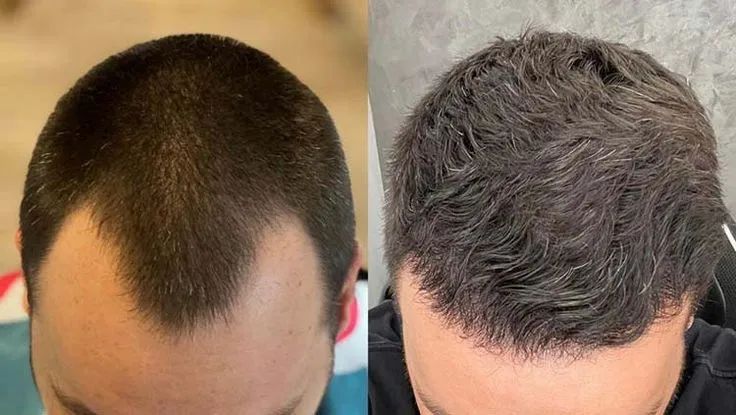 Prótese Capilar Masculina - Tellesperucas - Foto 2