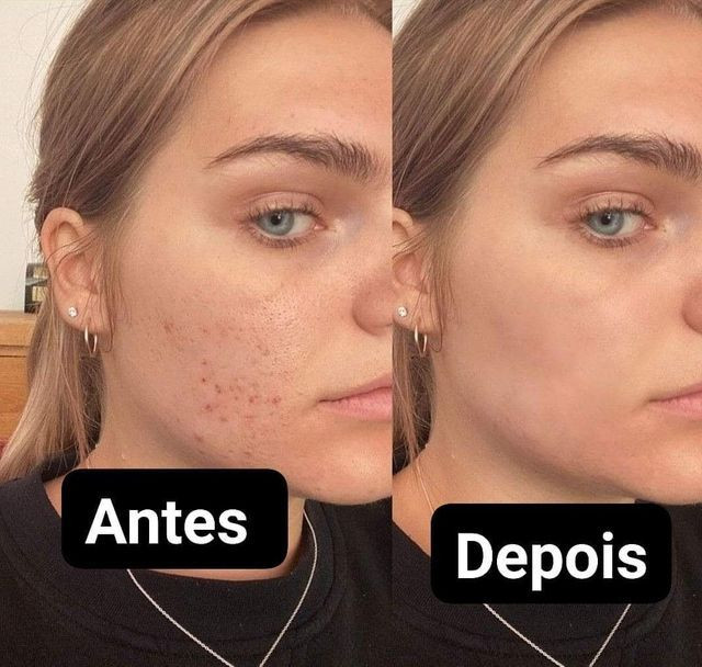 Tônico facial para eliminar Acnes e manchas importado dos EUA - Foto 2