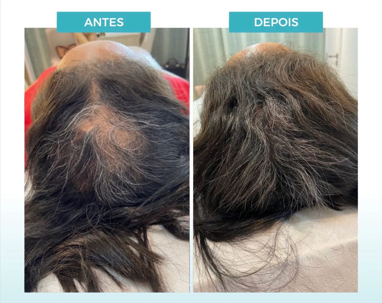 Tratar queda de cabelo - Foto 3