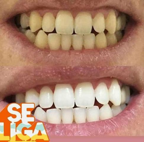 Clareamento dental