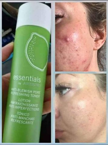 Tônico facial para eliminar Acnes e manchas importado dos EUA