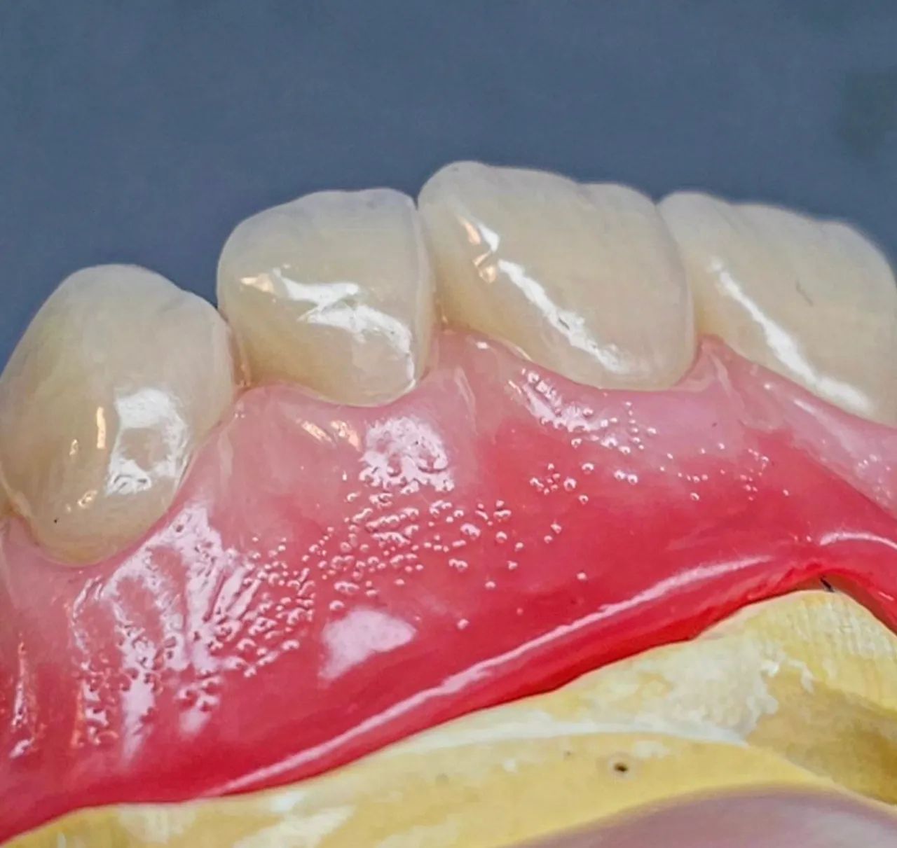 Seu melhor sorriso é  a melhor prótese  - Foto 3