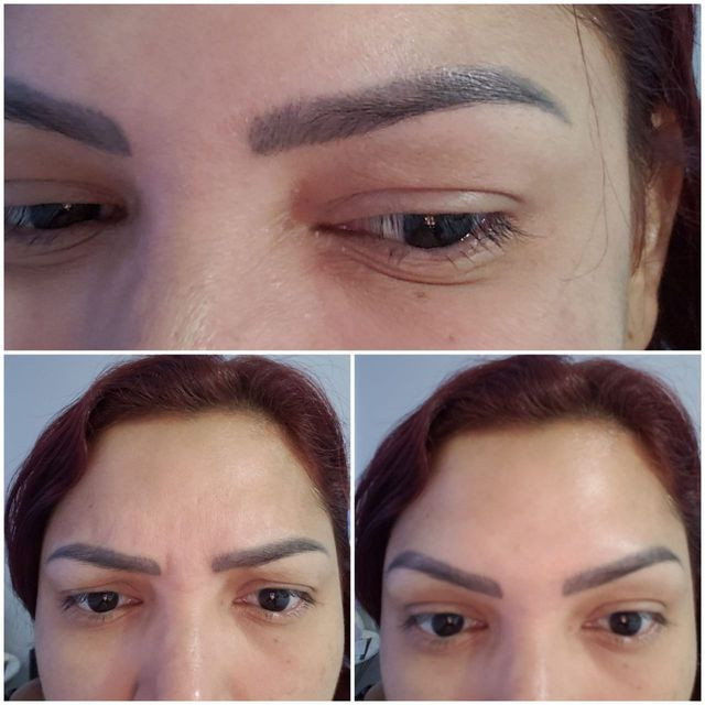 Botox (Toxina botulínica) - Foto 2
