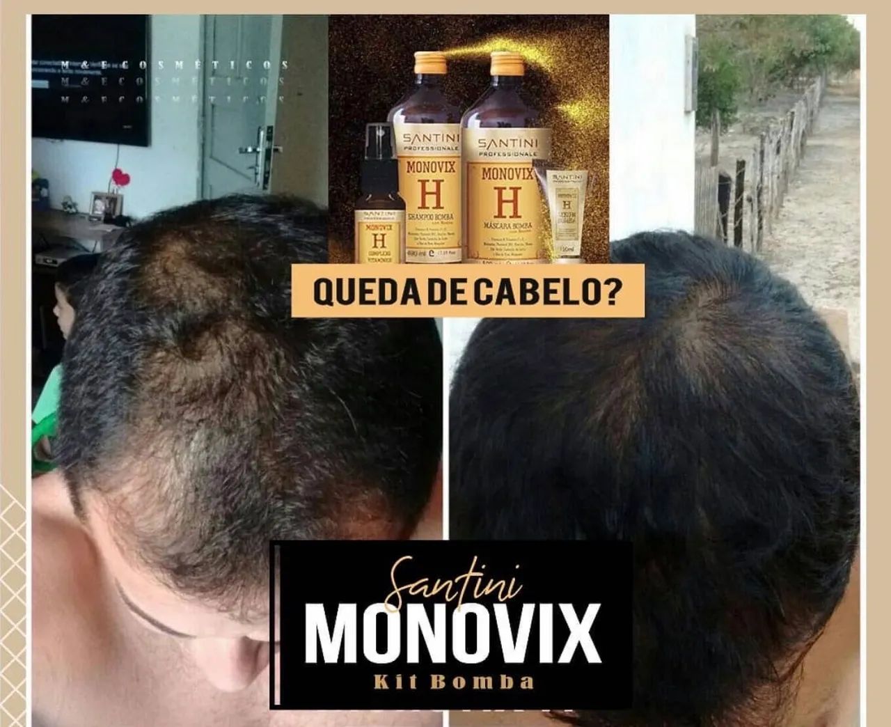     CABELO CAINDO, FRACO E SEM CRESCER? O KIT BOMBA É PRA VOCÊ! - Foto 4