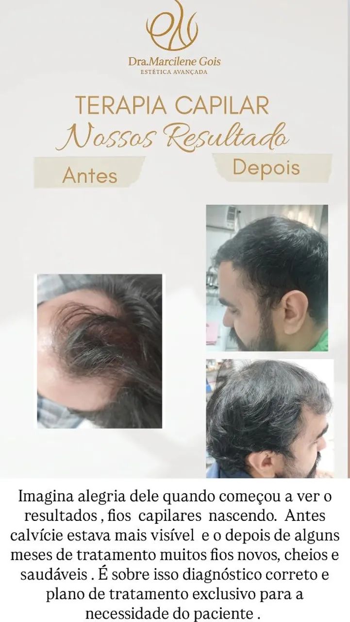 Queda de cabelo x Alopecia  - Foto 3