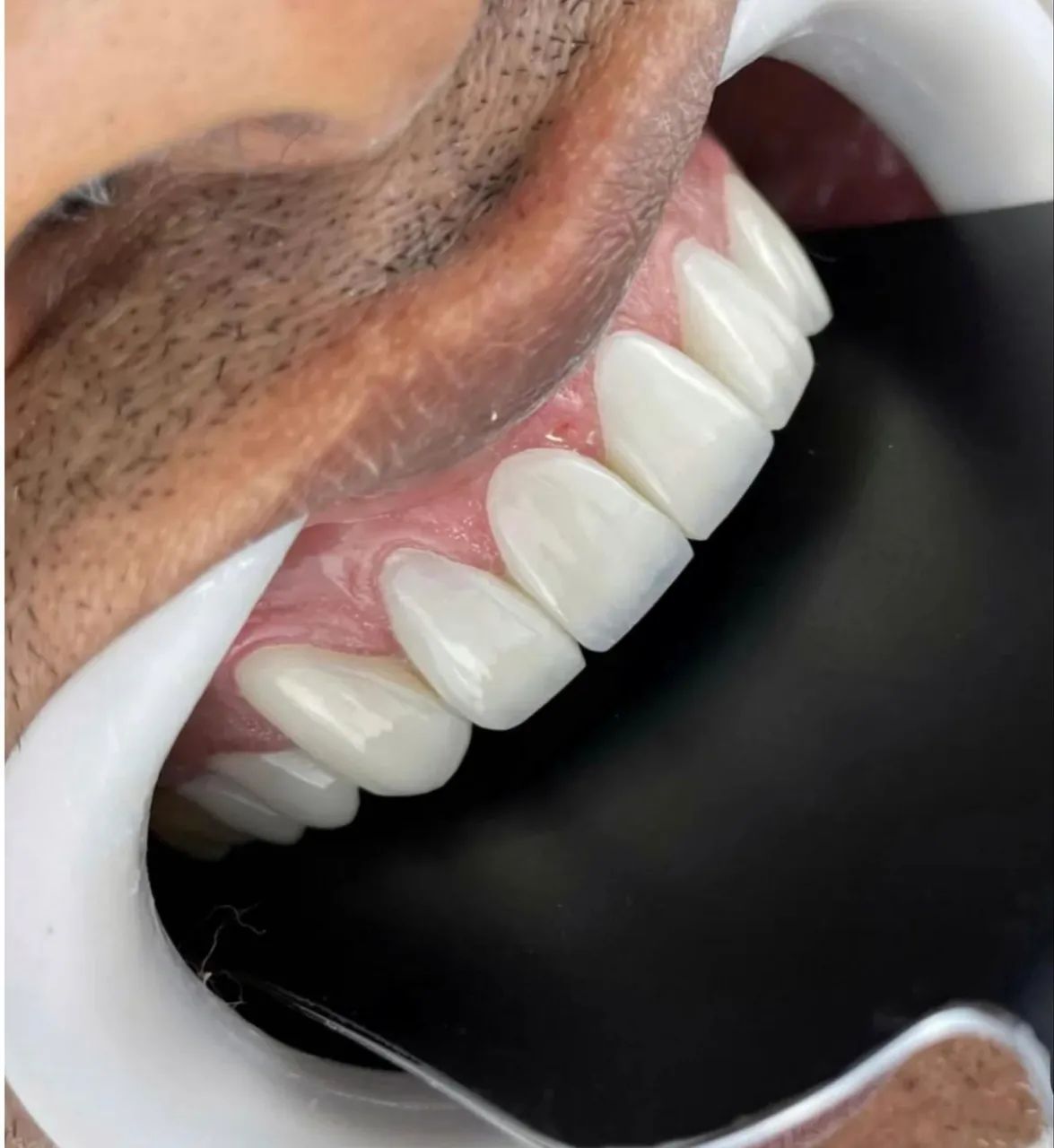 Facetas em resina / dentista 