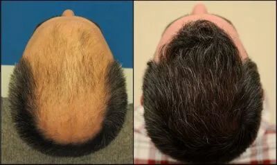 Prótese Capilar Masculina - Tellesperucas - Foto 3