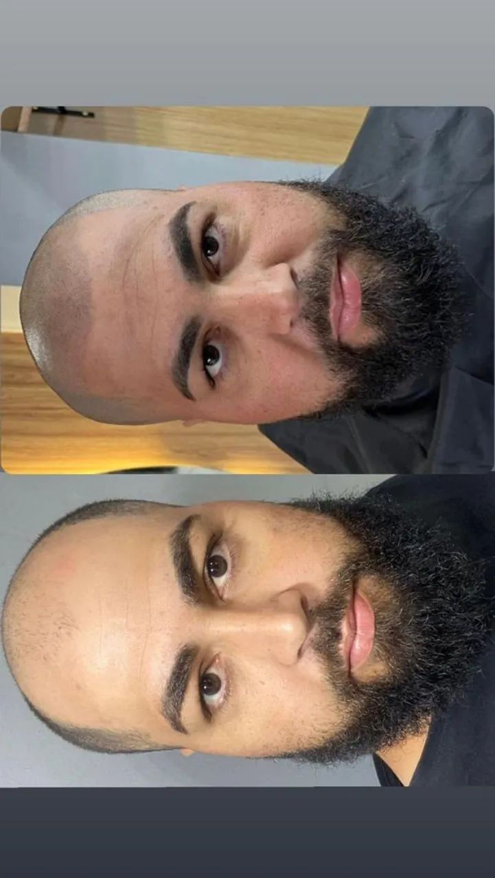 Cobertura de Calvície 