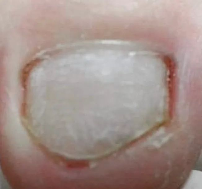 Podologo especializado em tratamento com Laser em micose de unha - Foto 5