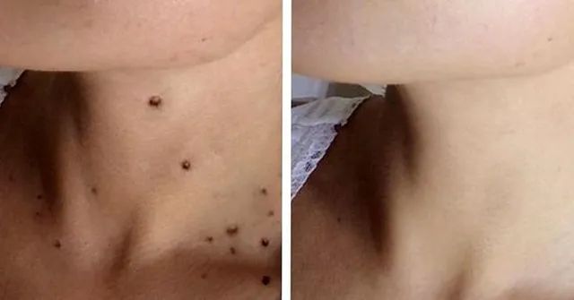 Retirada de verrugas e pintas - Foto 3