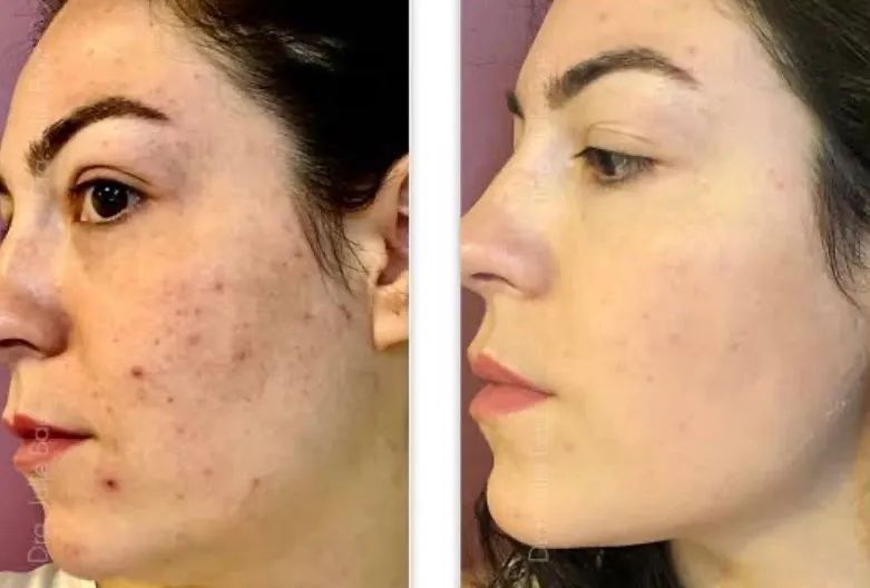 Limpeza de pele profunda e tratamento de Acne  - Foto 3