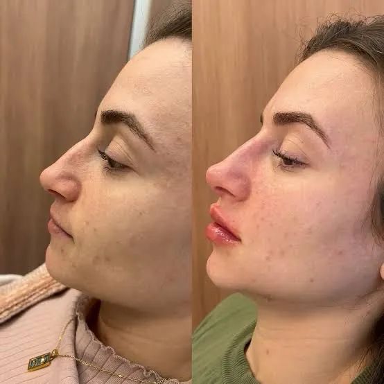 Perfiloplastia - R$1.599,00 - Foto 3
