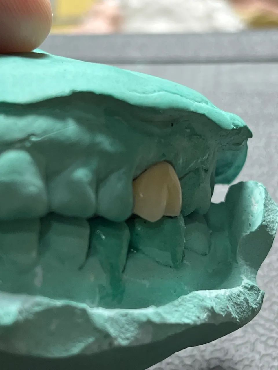 Seu melhor sorriso é  a melhor prótese  - Foto 4